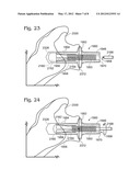 JOINT IMPLANT FIXATION SYSTEM diagram and image