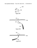 SYSTEMS, DEVICES, AND METHODS FOR TREATING PELVIC FLOOR DISORDERS diagram and image