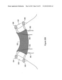 SYSTEMS, DEVICES, AND METHODS FOR TREATING PELVIC FLOOR DISORDERS diagram and image