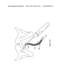 SYSTEMS, DEVICES, AND METHODS FOR TREATING PELVIC FLOOR DISORDERS diagram and image