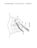 SYSTEMS, DEVICES, AND METHODS FOR TREATING PELVIC FLOOR DISORDERS diagram and image