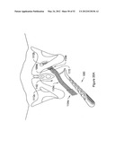 SYSTEMS, DEVICES, AND METHODS FOR TREATING PELVIC FLOOR DISORDERS diagram and image