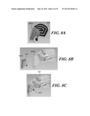 MODULAR ANTENNA FOR IMPLANTABLE MEDICAL DEVICE diagram and image