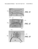 MODULAR ANTENNA FOR IMPLANTABLE MEDICAL DEVICE diagram and image