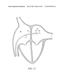 INTRA-ATRIAL IMPLANTS TO DIRECTIONALLY SHUNT BLOOD diagram and image