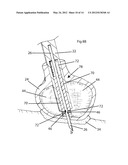 Tissue Desensitization Instrument & Method diagram and image