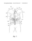 RENAL NERVE STIMULATION METHOD FOR TREATMENT OF PATIENTS diagram and image