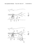 RENAL NERVE STIMULATION METHOD FOR TREATMENT OF PATIENTS diagram and image