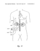 RENAL NERVE STIMULATION METHOD FOR TREATMENT OF PATIENTS diagram and image