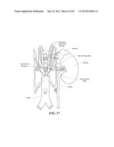 NEUROMODULATION CRYOTHERAPEUTIC DEVICES AND ASSOCIATED SYSTEMS AND METHODS diagram and image