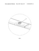 STEEL PLATE FOR FUNNEL CHEST ORTHOPAEDIC SURGERY diagram and image