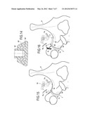 BONE FIXING SYSTEM diagram and image