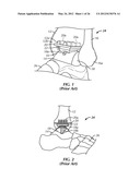 SURGICAL INSTRUMENTATION AND METHODS OF USE FOR IMPLANTING A PROSTHESIS diagram and image