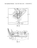 SURGICAL INSTRUMENTATION AND METHODS OF USE FOR IMPLANTING A PROSTHESIS diagram and image