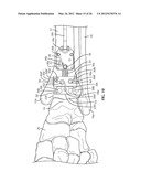 SURGICAL INSTRUMENTATION AND METHODS OF USE FOR IMPLANTING A PROSTHESIS diagram and image