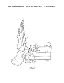 SURGICAL INSTRUMENTATION AND METHODS OF USE FOR IMPLANTING A PROSTHESIS diagram and image