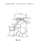 SURGICAL INSTRUMENTATION AND METHODS OF USE FOR IMPLANTING A PROSTHESIS diagram and image