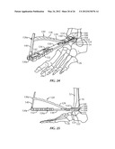 SURGICAL INSTRUMENTATION AND METHODS OF USE FOR IMPLANTING A PROSTHESIS diagram and image