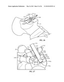 SURGICAL INSTRUMENTATION AND METHODS OF USE FOR IMPLANTING A PROSTHESIS diagram and image