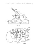 SURGICAL INSTRUMENTATION AND METHODS OF USE FOR IMPLANTING A PROSTHESIS diagram and image