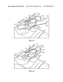 SURGICAL INSTRUMENTATION AND METHODS OF USE FOR IMPLANTING A PROSTHESIS diagram and image