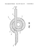 BONE GRAFT INJECTION SYRINGE diagram and image