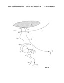 APPARATUS AND METHOD FOR PERFORMING OCULAR SURGERY diagram and image