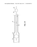 PERCUTANEOUS THROMBUS EXTRACTION DEVICE AND METHOD diagram and image