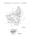 SYSTEMS AND METHODS FOR TREATMENT OF DRY EYE diagram and image