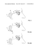 SYSTEMS AND METHODS FOR TREATMENT OF DRY EYE diagram and image