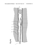 SURGICAL CUTTING INSTRUMENT diagram and image