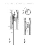 SURGICAL CUTTING INSTRUMENT diagram and image