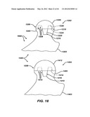 Punch, Implant and Associated Method diagram and image