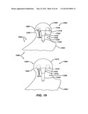 Punch, Implant and Associated Method diagram and image