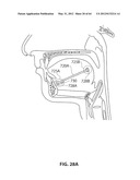 SYSTEMS AND METHODS FOR TREATMENT OF SLEEP APNEA diagram and image