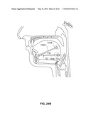 SYSTEMS AND METHODS FOR TREATMENT OF SLEEP APNEA diagram and image