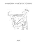 SYSTEMS AND METHODS FOR TREATMENT OF SLEEP APNEA diagram and image