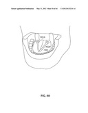 SYSTEMS AND METHODS FOR TREATMENT OF SLEEP APNEA diagram and image