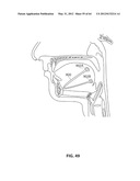 SYSTEMS AND METHODS FOR TREATMENT OF SLEEP APNEA diagram and image