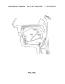 SYSTEMS AND METHODS FOR TREATMENT OF SLEEP APNEA diagram and image