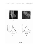 Spatio-Temporal Analysis for Automatic Contrast Injection Detection on     Angiography During Trans-Catheter Aortic Valve Implantation diagram and image