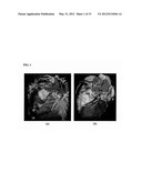 Method and System for Heart Isolation in Cardiac Computed Tomography     Volumes for Patients with Coronary Artery Bypasses diagram and image