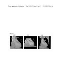 Method and System for Heart Isolation in Cardiac Computed Tomography     Volumes for Patients with Coronary Artery Bypasses diagram and image