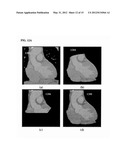 Method and System for Heart Isolation in Cardiac Computed Tomography     Volumes for Patients with Coronary Artery Bypasses diagram and image