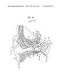 HEARING PROSTHESIS HAVING A FLEXIBLE ELONGATE ENERGY TRANSFER MECHANISM diagram and image