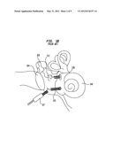 HEARING PROSTHESIS HAVING A FLEXIBLE ELONGATE ENERGY TRANSFER MECHANISM diagram and image