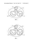 METHOD AND APPARATUS FOR EXTERNAL STABILIZATION OF THE HEART diagram and image