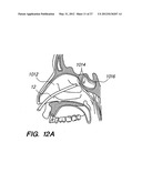 Endoscopic Methods and Devices for Transnasal Procedures diagram and image