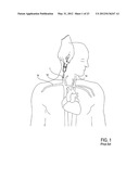 Methods of Transvascular Retrograde Access Placement and Devices for     Facilitating the Placement diagram and image