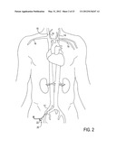 Methods of Transvascular Retrograde Access Placement and Devices for     Facilitating the Placement diagram and image